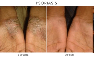 Psoriasis tratament crema